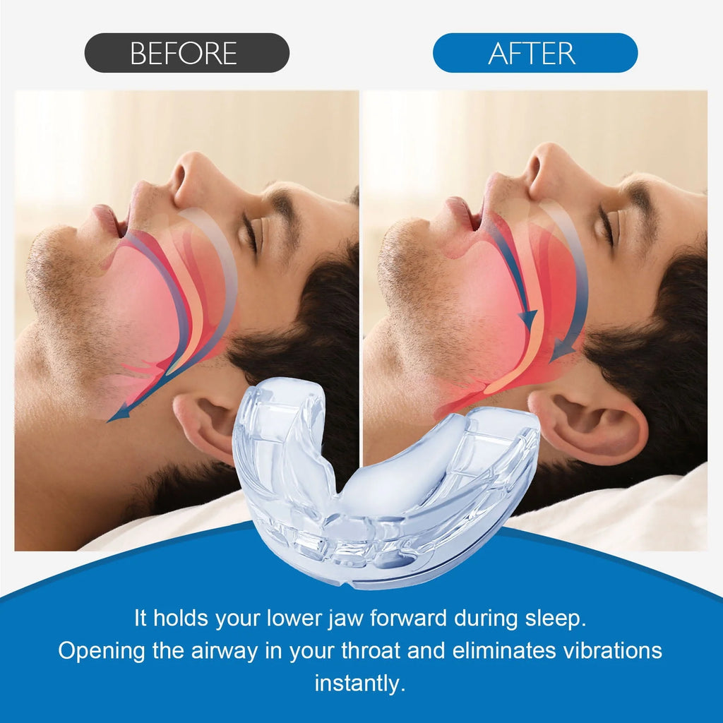 Anti Snoring Mouth Guard D193113